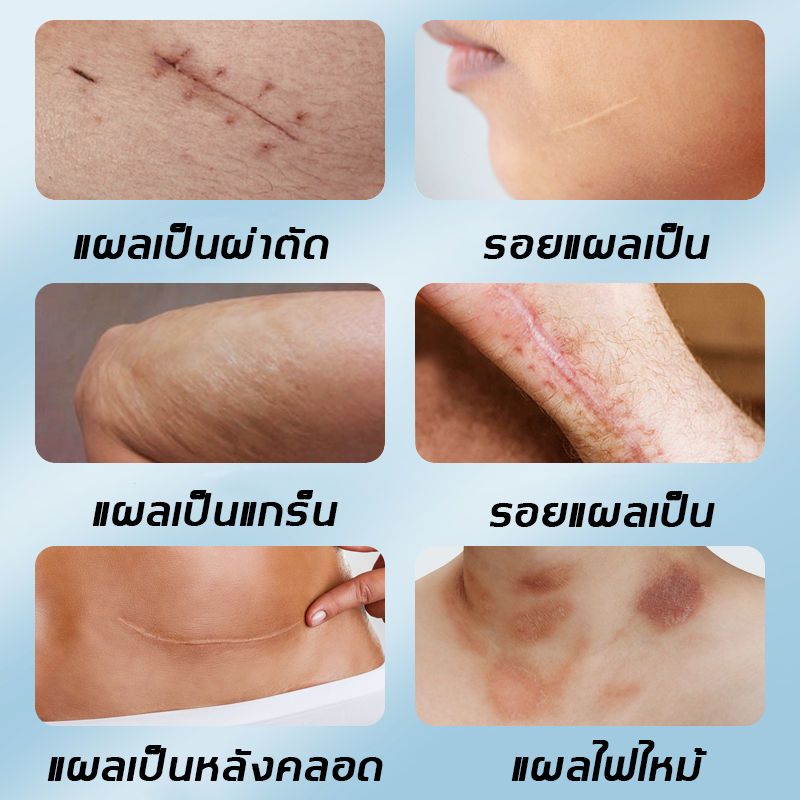 มีสินค้าพร้อมจัดส่ง🥰 South Moon แผ่นแปะแผลเป็น ปิดรอยแผลเป็น แผลเป็น ตัดตามต้องการ ลดรอยแผลเป็นนูนทั้งเก่าใหม่ รอยไหม้และแผลผ่าตัด (ลดรอยเเผลเป็น ครีมทาแผลเป็น ลดแผลเป็นนูน แผลเป็นนูน แผลคีลอยด์  แผ่นแปะคีลอยด์ ซิลิโคนแผลเป็น แผลนูน) scar silicone