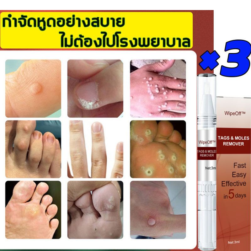 ขี้แมลงวัน หูดตาปลาและติ่งเนื้อ ของแท้ Corns warts removal พร้อมส่ง ไฝ ครีมแต้มหูด ลอกหูดตาปลา ปลอดภัยไม่เจ็บ