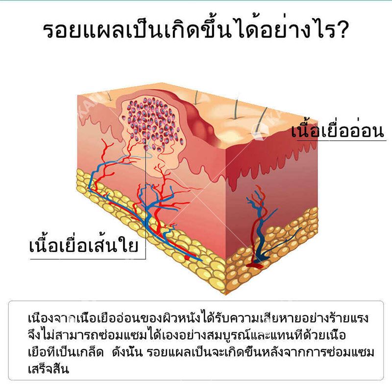 7วัน เห็นผล DR.MIDER นำเข้าจากเกาหลี ครีมลดรอยแผลเป็น มยาทาแผลเป็นนูน ครีมลบแผลเป็น ยารักษาแผลเป็น ครีมลบรอยแผลเป็น