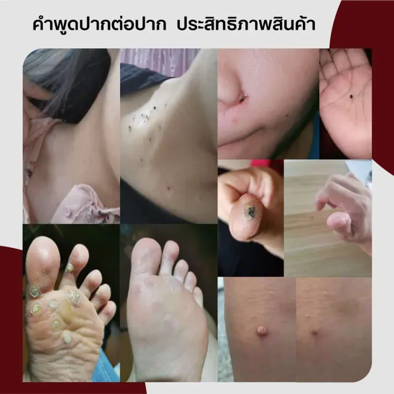 หูดและติ่ง ยาทาหูด แคลลัสและรากหนาม ช่วยให้หูดหรือตาปลาหลุดออก หูดตาปลา ลอกหูดตาปลา 20g