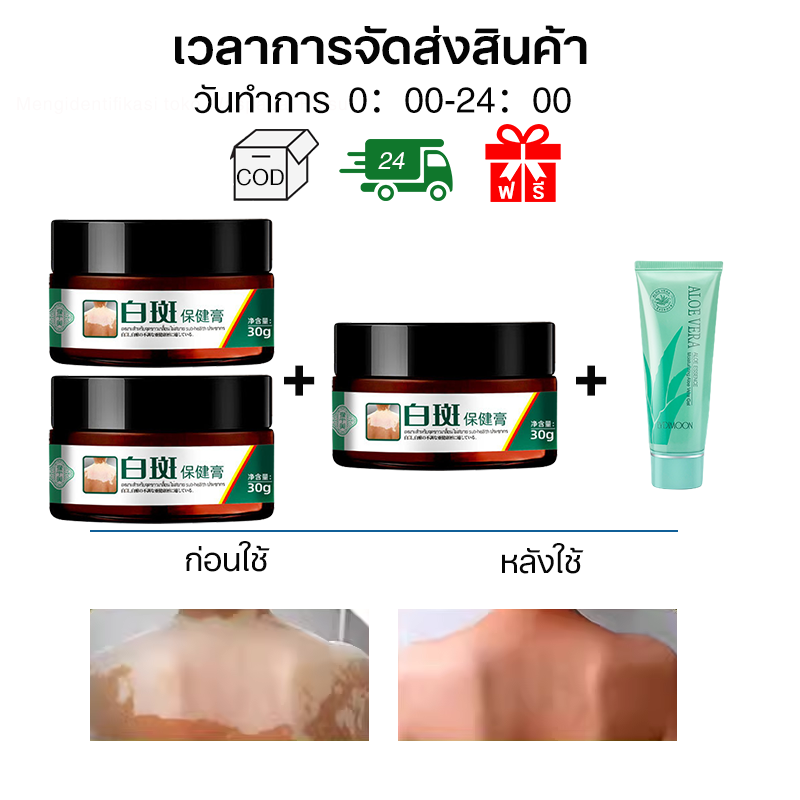 ครีมทาด่างขาว 30g สารสกัดจากสมุนไพร ด่างขาวที่หน้า ด่างขาวที่หลัง ด่างขาวที่แขน ผลิตภัณฑ์กระตุ้นการสร้างเม็ดสีของผิว Vitiligo