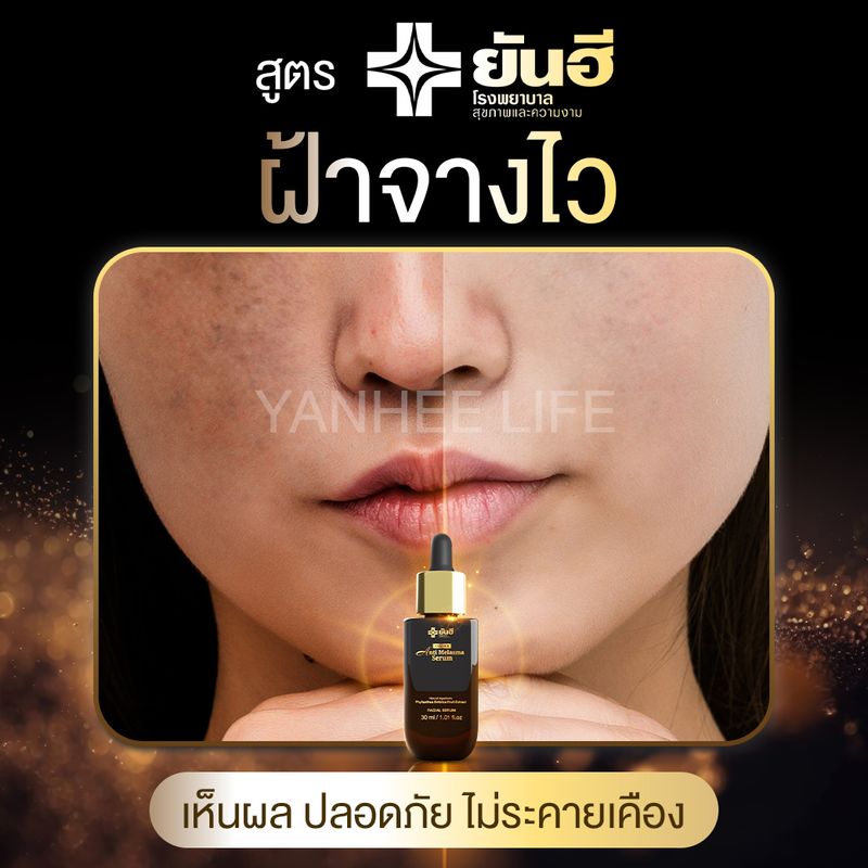 ยันฮี:ANTI MELASMA SERUM,1 ขวด แถม สบู่ 1,Free Shipping