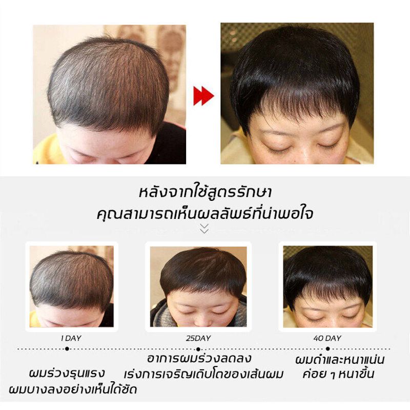 มีผลใน 10 วัน QITA เซรั่มปลูกผม สารสกัดจากสมุนไพร บำรุงรูขุมขน เสริมสร้างรากผมให้แข็งแรง เหมาะสม นอนดึกแล้วผมร่วง ผมร่วงเนื่องจากความเครียด ผมร่วงหลังคลอด ผมร่วงมันเยิ้ม น้ำยาปลูกผม น้ำยาเร่งผมยาว สเปรย์เซรั่มปลูกผม