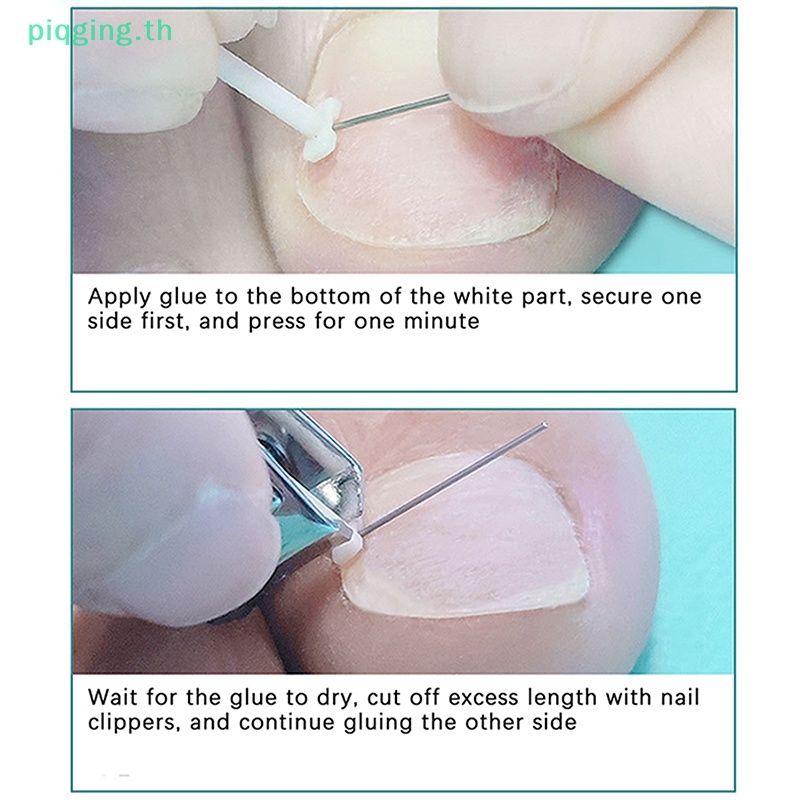Piqging คลิปหนีบเล็บขบ รักษาเล็บขบ เล็บเท้า แบบมืออาชีพ