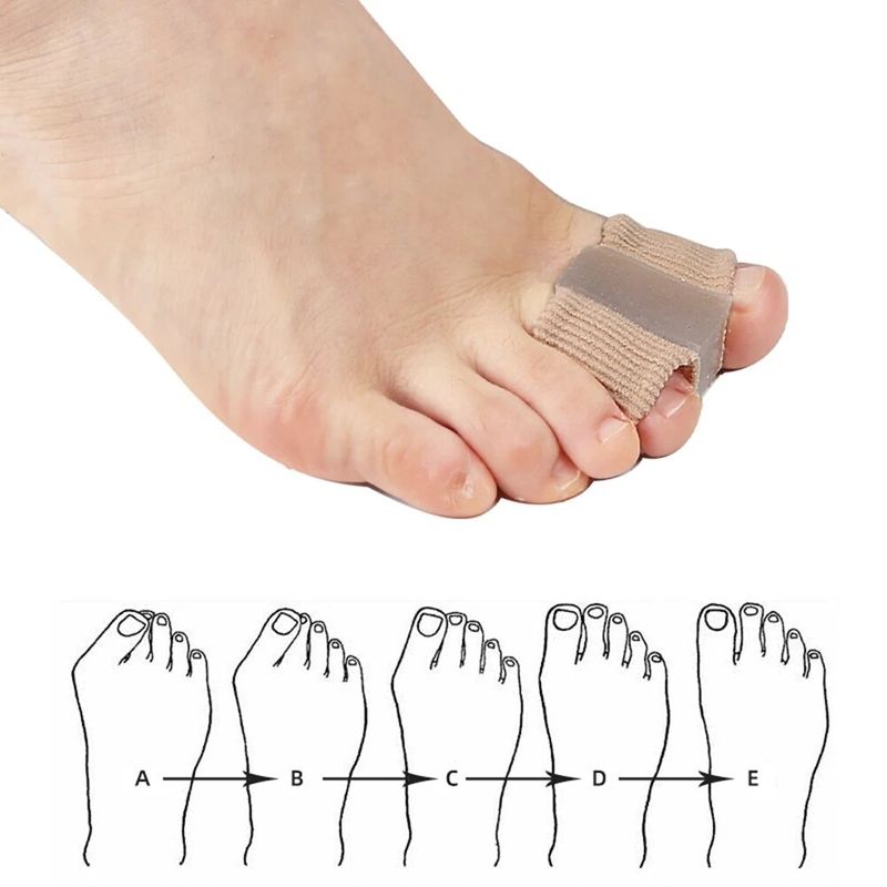 VTTO 1PCS Feet Care Hallux Valgus Thumb Orthopedic Supplies วงเล็บที่ถูกต้องทุกวันซิลิโคน Toe Big Bone Foot Care เครื่องมือ Foot Care