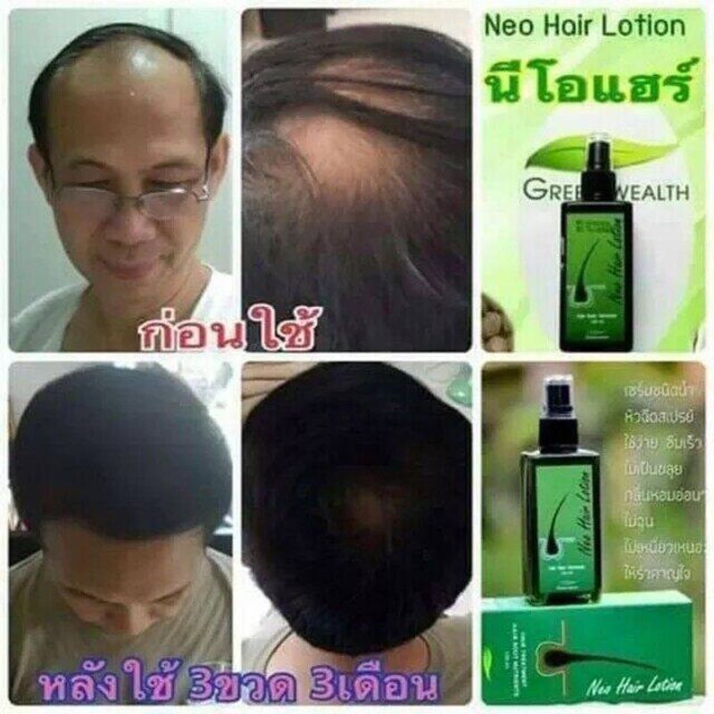 Neo Hair Lotion,3 ขวด 360ml