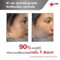 LYSE เซรั่มฝ้า กระ จุดด่างดำ เซรั่มผลัดเซลล์ผิว  กระ จุดด่างดำ รอยดำ ให้จางลง ANTI Melasma 30ml