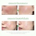 SKINTIFIC  ANCE CLAY MUSK COLLCTION ลดสิว ลดรอยสิว ลอกสิวเสี้ยน สิว ลดรอยแดง มาส์กโคลน ลดรอยแดงจากสิว (MUGWORt/ VOLCANO)