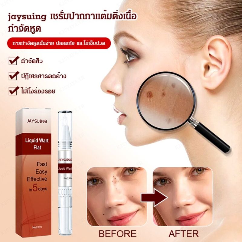 พร้อมส่ง ยาทาหูด หูดและติ่ง ลอกหูดตาปลา แคลลัสและรากหนาม ขจัดติ่งเนื้อ หูดข้าวสุก ที่จี้ไฝ ช่วยให้หูดหรือตาปลาหลุดออก