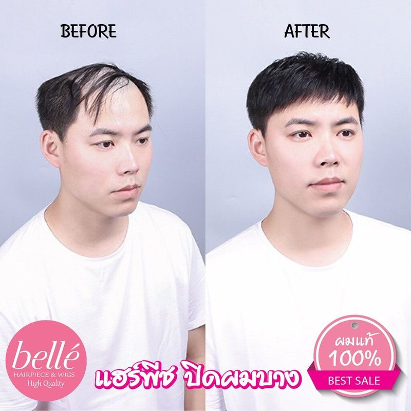 วิกผม BELLE  ย้อมได้ วิกผมปิดผมบาง ปิดหัวล้าน ผู้ชาย สีดำธรรมชาติ (พร้อมส่ง)