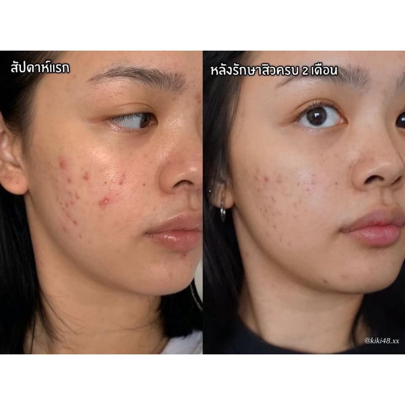 ครีมลดสิวอุดตัน Blossom Post Acne ผลัดเซลล์ผิวอย่างอ่อนโยน ลดรอยดำจากสิว สูตรคลินิก