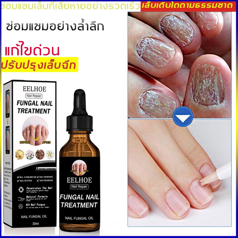 เซรั่มเล็บ เซรั่มซ่อมแซมเล็บ Nail Fungal Infection ยาแก้เชื้อราที่เล็บ ยากันเชื่อราเล็บ บำรุงเล็บเสีย บำรุงเล็บมือ（น้ำมันบำรุงเล็บ ครีมบำรุงเล็บ ยาแก้เล็บขบ เชื้อราเล็บมือ ยาหยอดเล็บ ครีมบำรุงซ่อมแซมเล็บ ครีบบำรุงเล็บ เซรั่มเชื้อราเล็บ น้ำยาเล็บขบ）