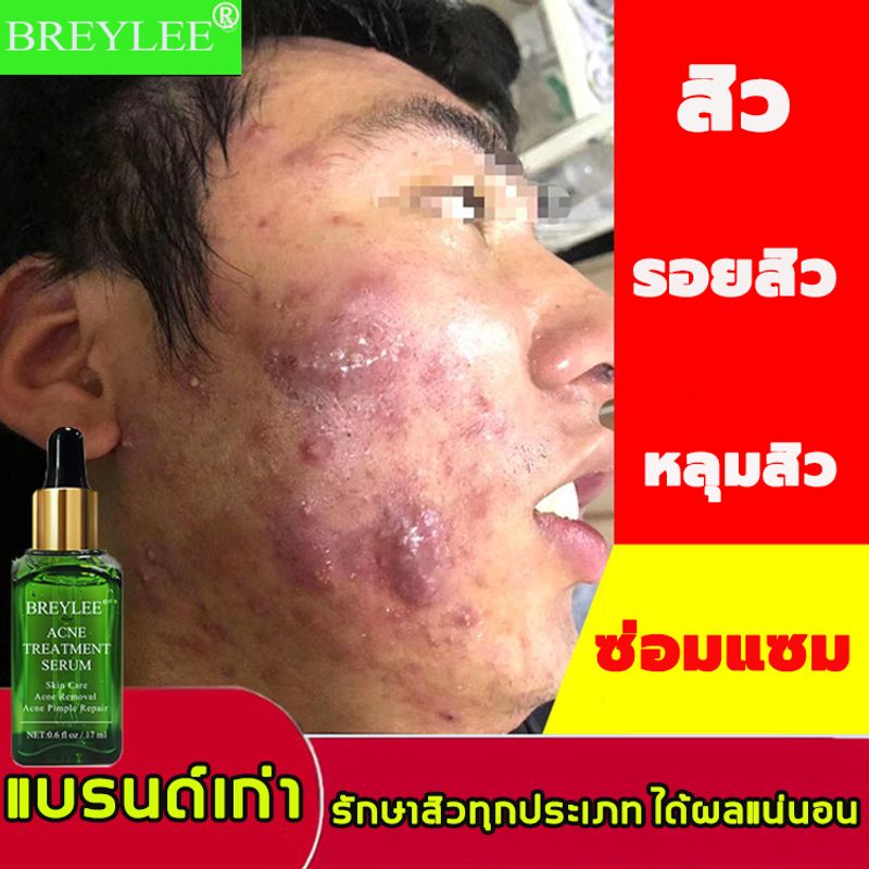 BREYLEEเซรั่มทาสิว17mlครีมลดสิว สิวอุดตัน สิวผด ไม่มีหัว หลุมสิว รอยดำจากสิว รอยแดง ครีมแต้มสิว เจลทาสิว เจลแต้มสิว ครีมกำจัดสิว ครีมทาสิว เจวแต้มสิว ครีมสลายสิว ครีมทาสิวต่างๆ ครีมทารอยสิว เซรั่มทารอยสิว เจลทาสิว เซรั่มหน้าใส เซรั่มบำรุงสิว เจลรักษาสิว