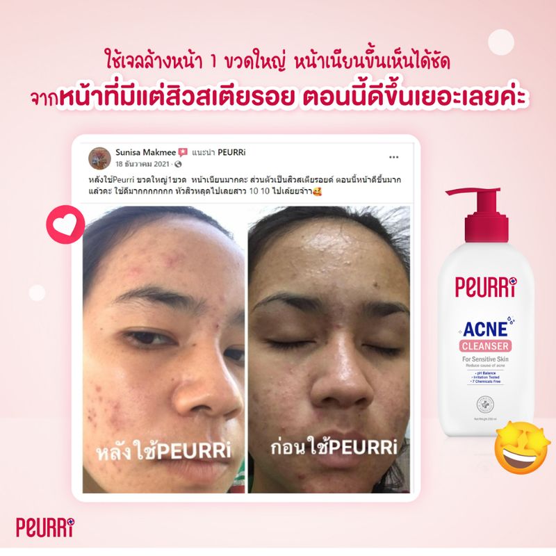 PEURRi:Acne Cleanser250ml + Anti Gel Acne8g + Dragon's Blood Scar Gel 8g,{"propIds":"","propNames":""}