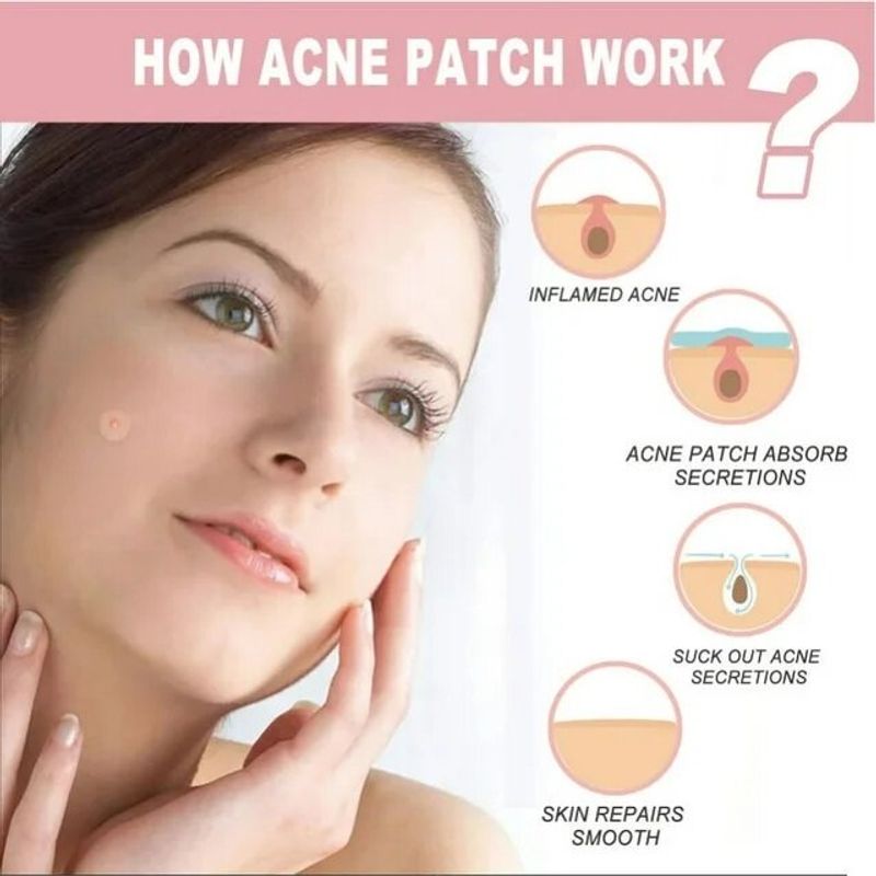 Acne patch แผ่นแปะสิว [72 ชิ้น] [1 กล่อง] แผ่นไฮโดรคอลลอยด์ ดูดสิว ลดรอยแดง สิวอักเสบ