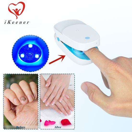 iKeener Nail fungus laser 905nm phototherapy paronychia foot paronychia foot care home phototherapy paronychia mini toenail onychomycosis therapy LED cure